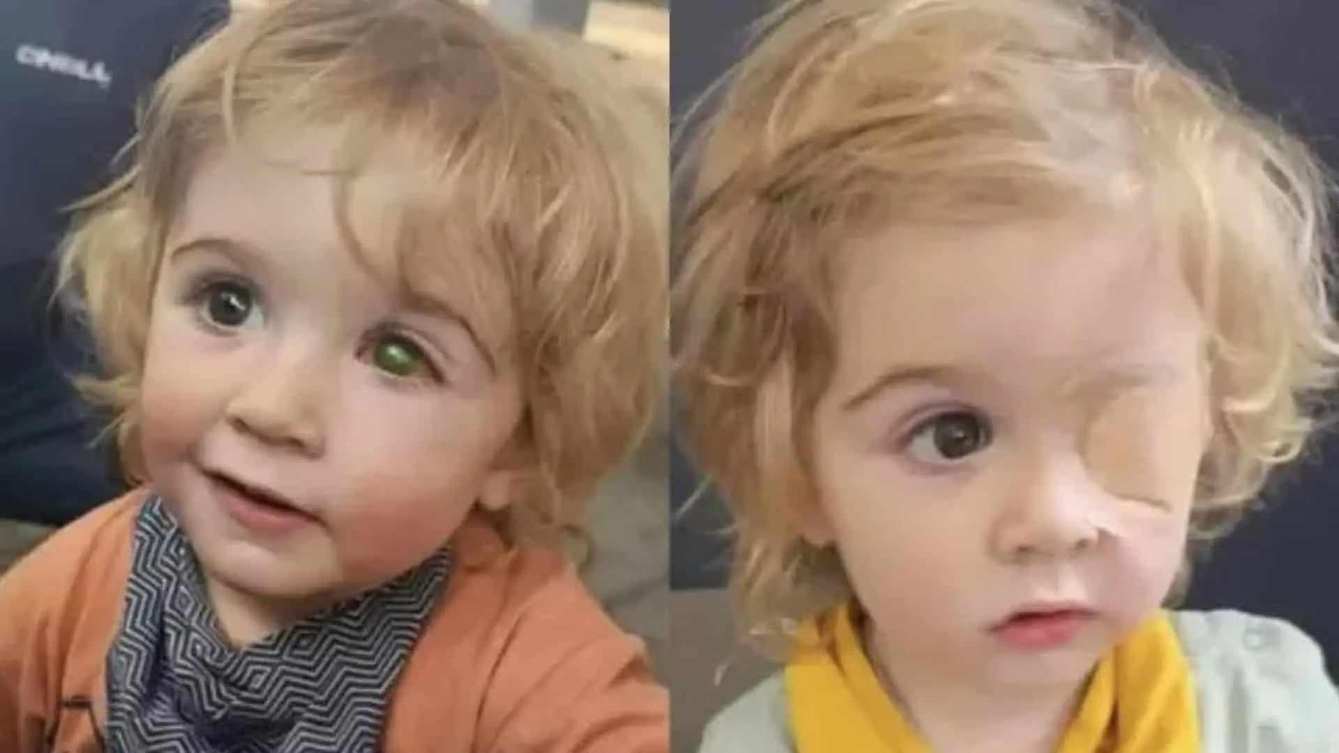 Dvojročný Juwan stratil zrak na ľavé oko po tom, čo jednoduchý bozk preniesol vírus oparu do očnej buľvy