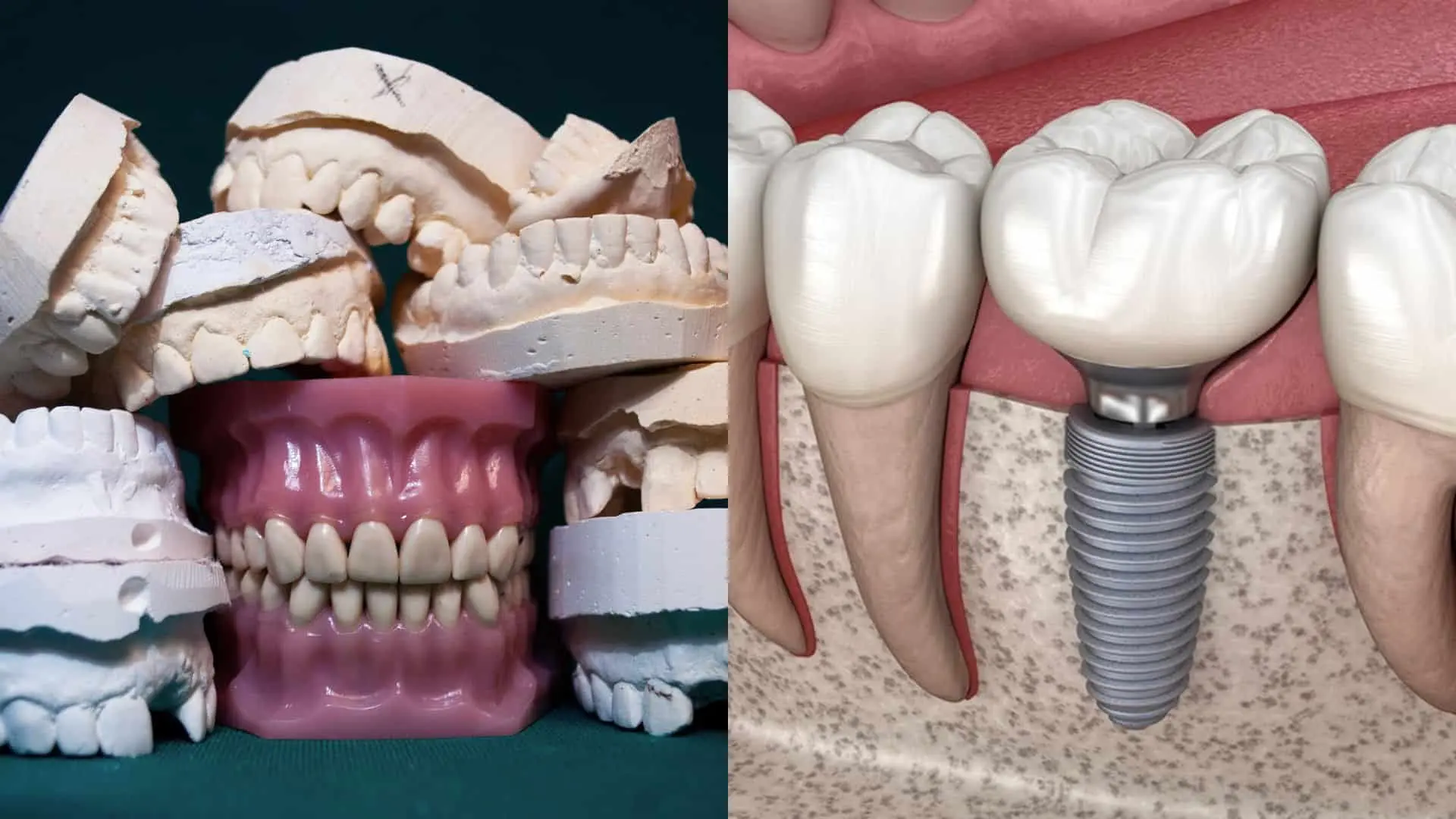 Strata zubov neovplyvňuje iba vzhľad, ale aj kvalitu života