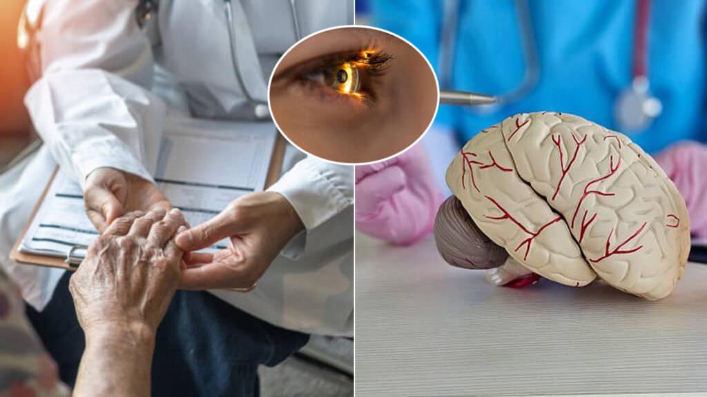 parkinsonova choroba, oko, mozog