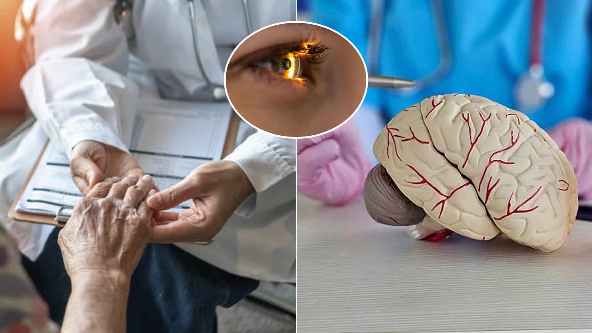 parkinsonova choroba, oko, mozog