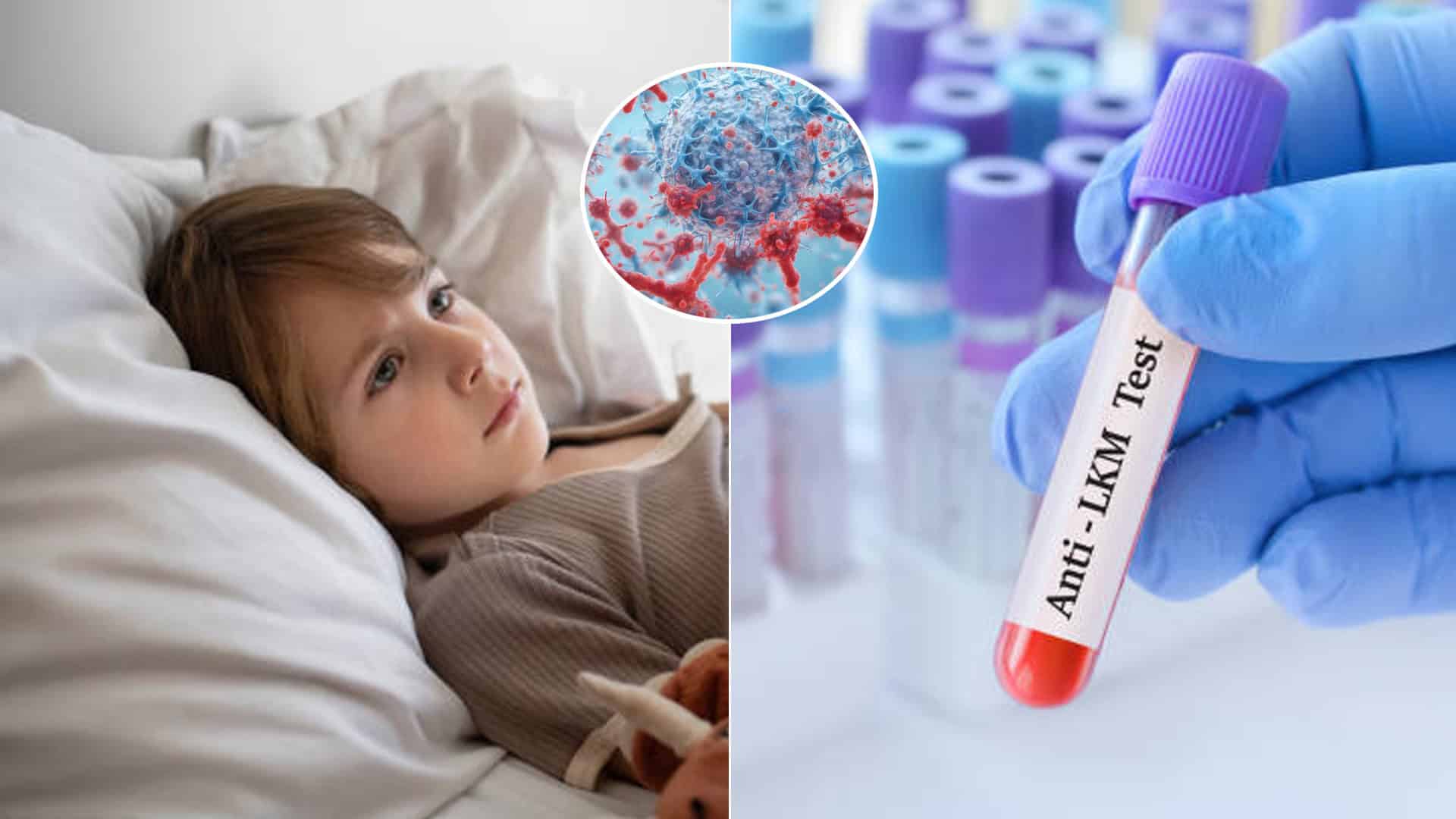 hepatitída