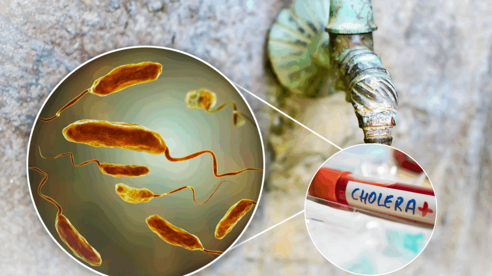 cholera