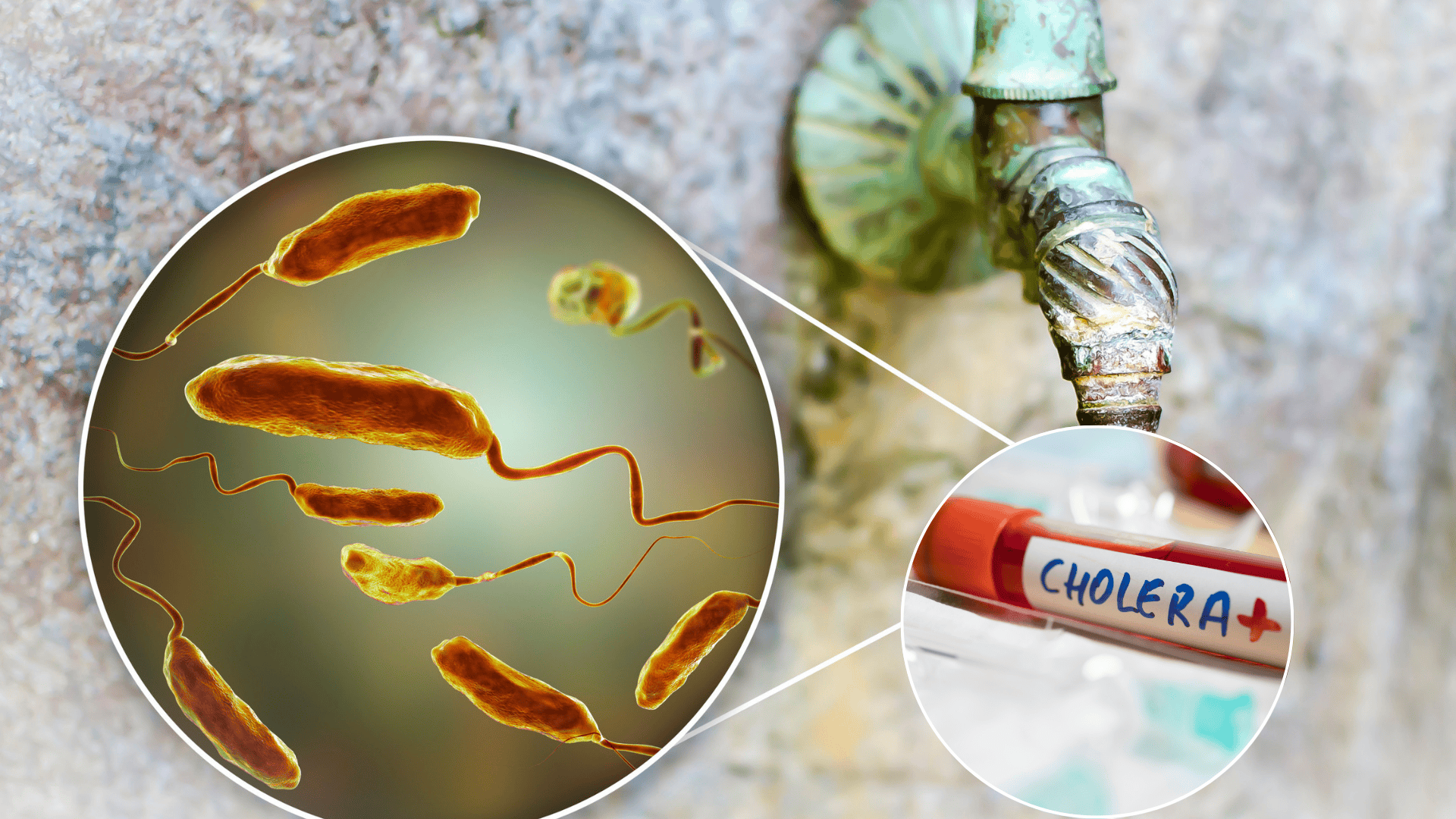 cholera