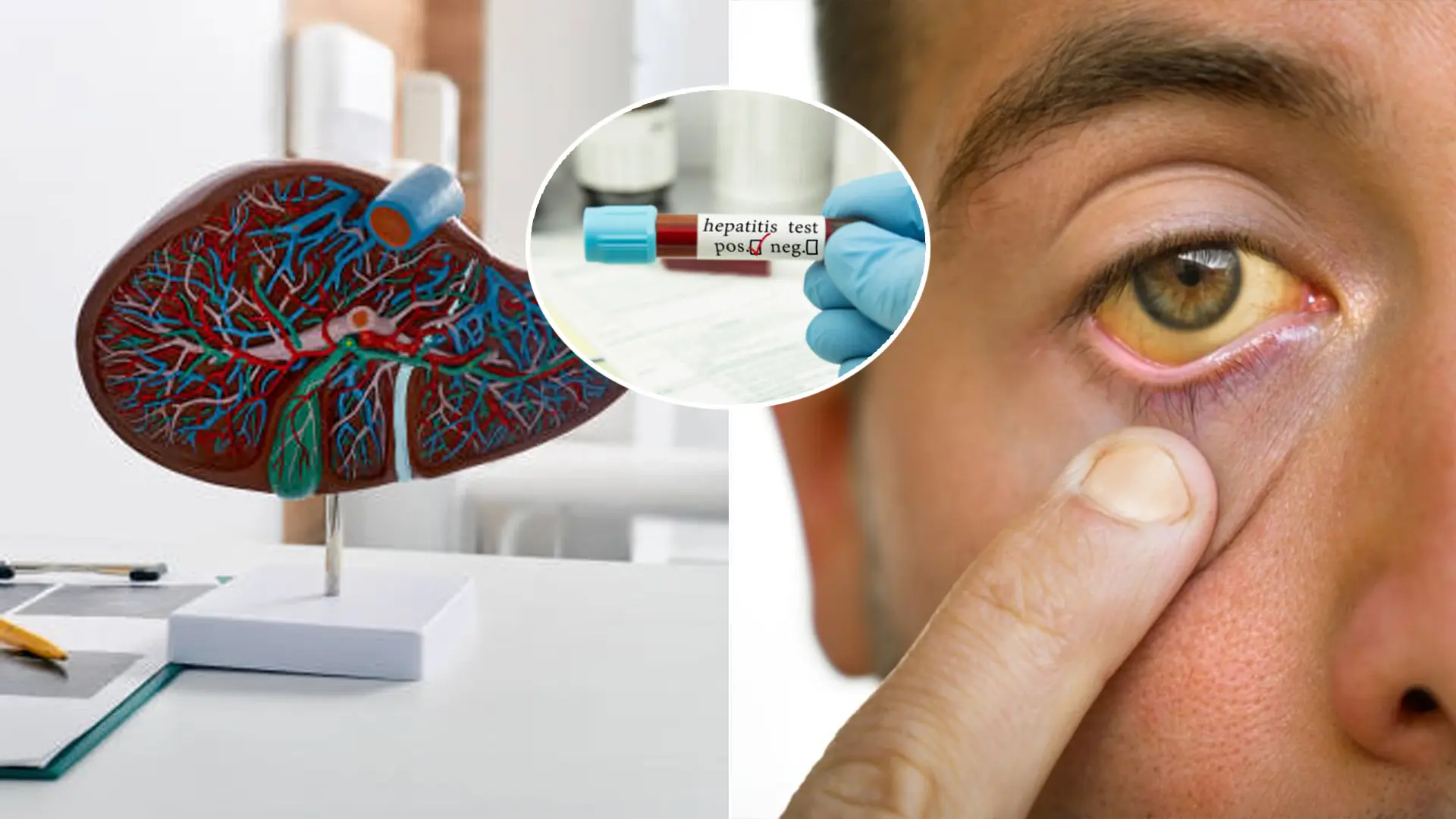 hepatitída A pacient pečeň