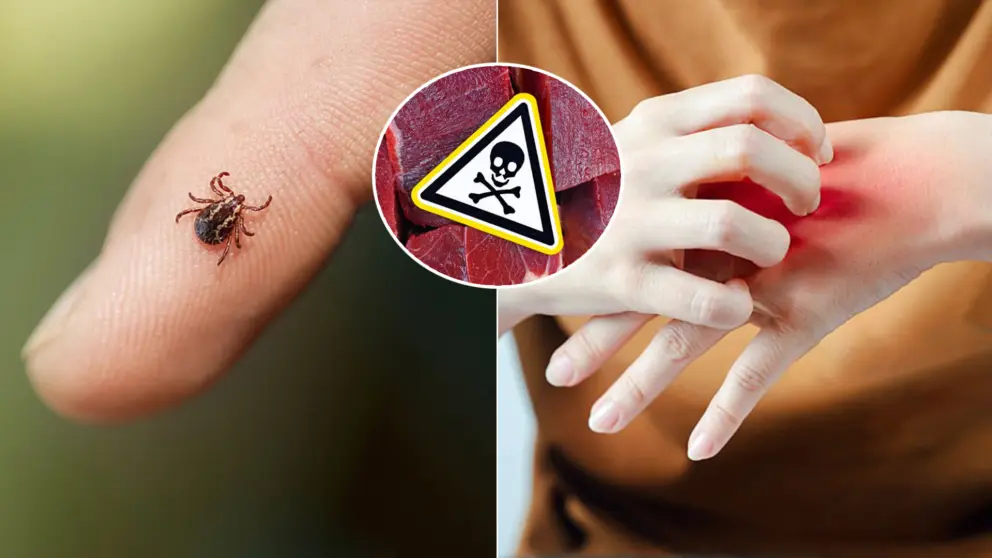 uštipnutie kliešť alergia na mäso