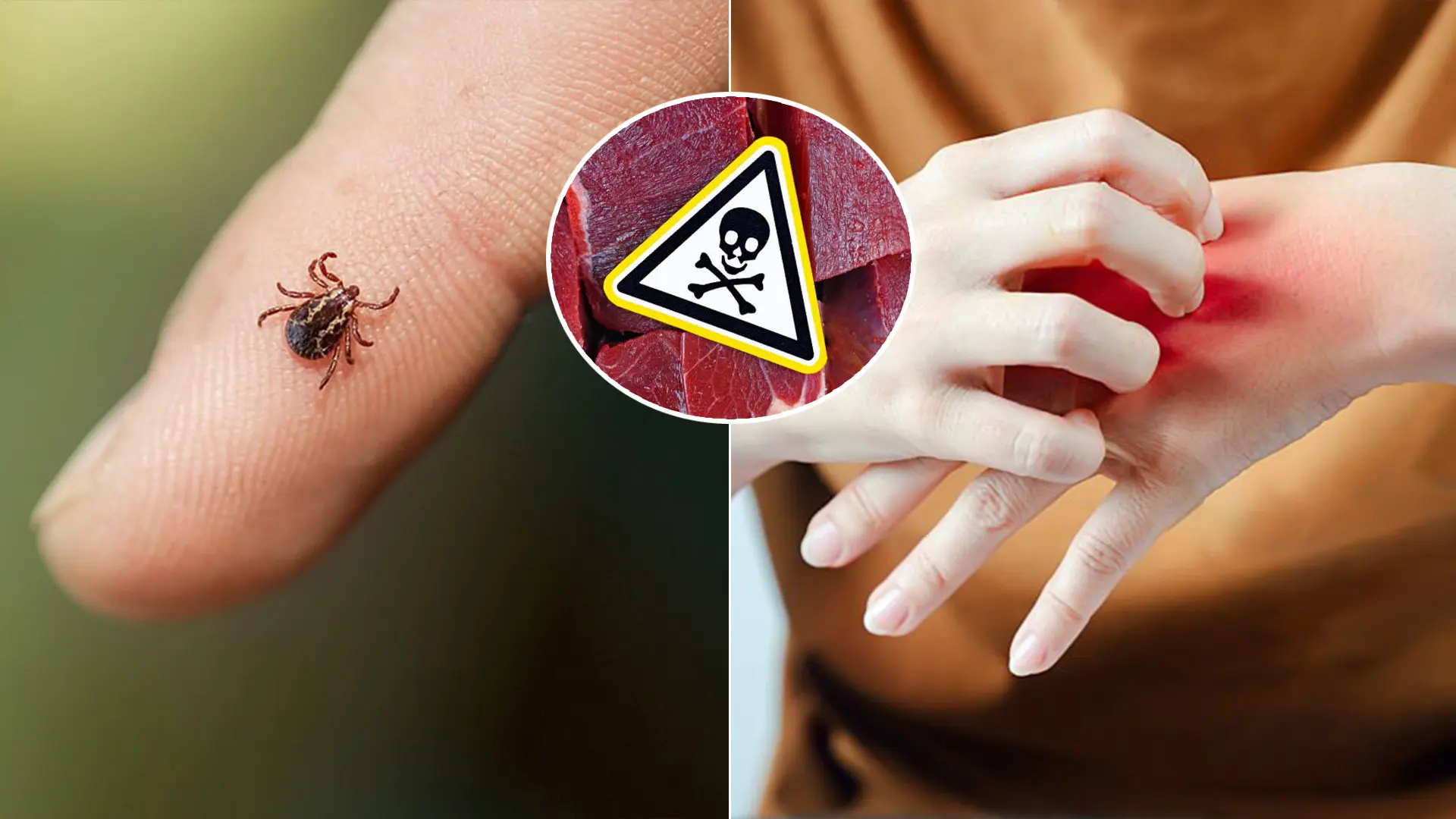 uštipnutie kliešť alergia na mäso