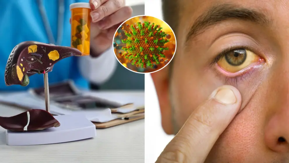 hepatitída A žltačka