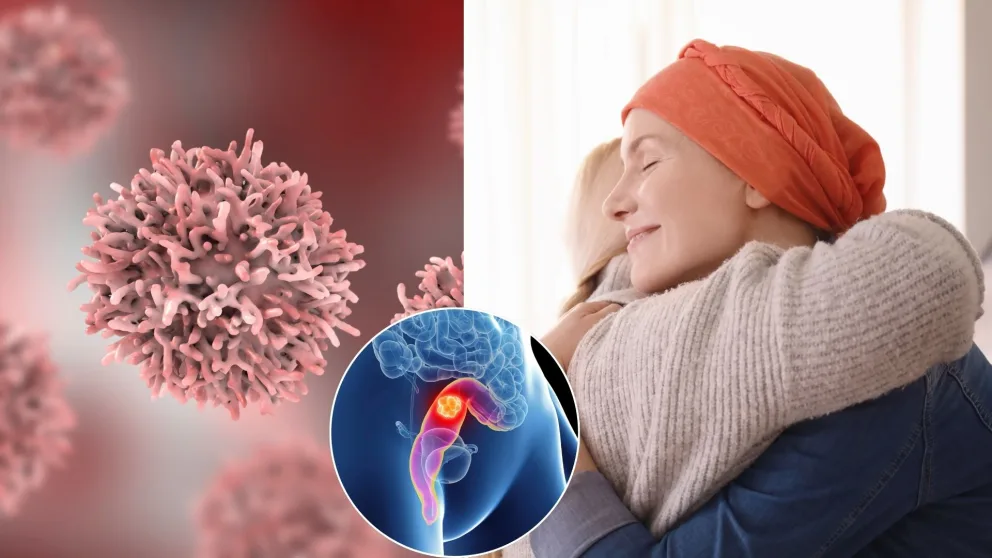 rakovina, konečník