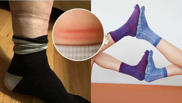 Prečo sa vám po ponožkách objavujú hlboké ryhy na nohách? Môže to byť varovný signál, že vaše telo zadržiava tekutiny alebo že niečo nie je v poriadku s cievami či lymfatickým systémom.
